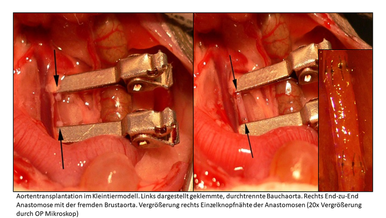 Vorher-Nachher-Bild einer Aorta. Links eine durchtrennte Bauchaorta, welche an zwei Metallclips fixiert ist. Rechts die transplantierte Aorta, welche unter einem OP Mikroskop zusammengenäht wurde.